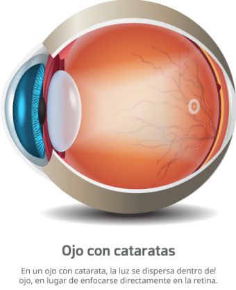 OJO-CATARATA-07