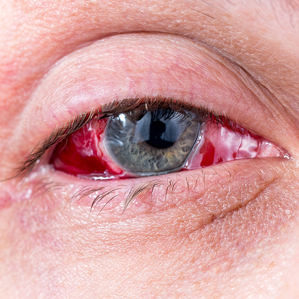 desprendimiento-de-retina