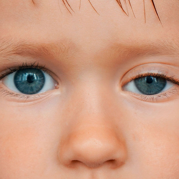 ptosis-ninos