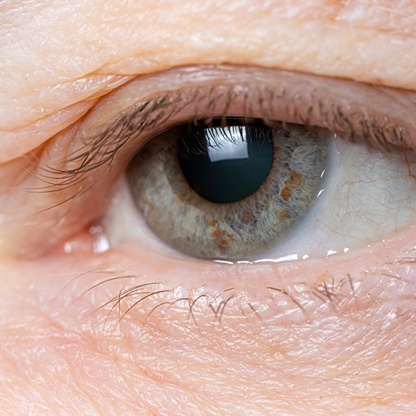 ptosis